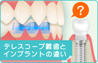 テレスコープ義歯とインプラントの違い